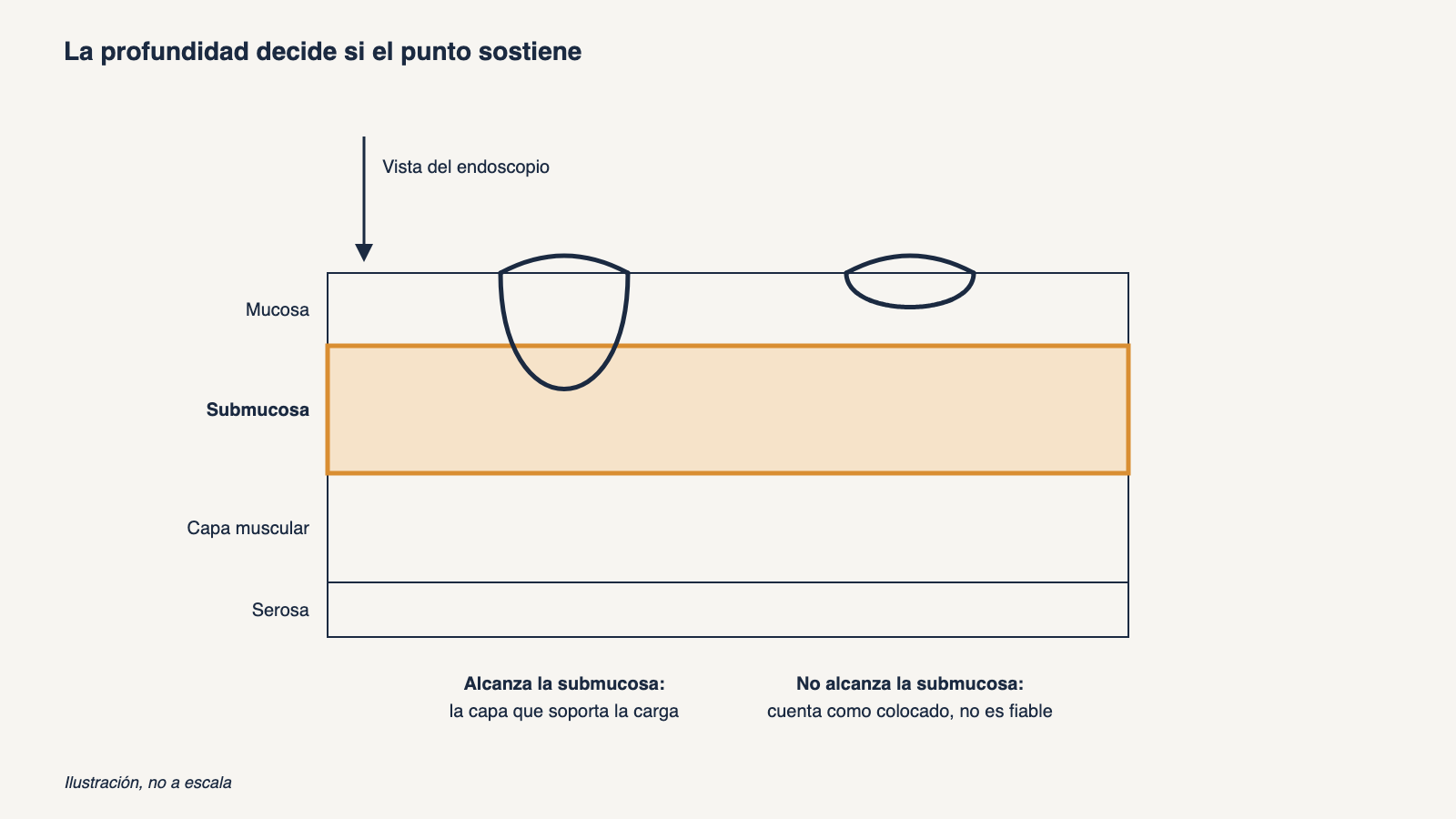 Corte ilustrativo de la pared gastrointestinal en cuatro capas, mucosa, submucosa, capa muscular y serosa, con un punto profundo que atraviesa la submucosa resaltada y un punto superficial limitado a la mucosa