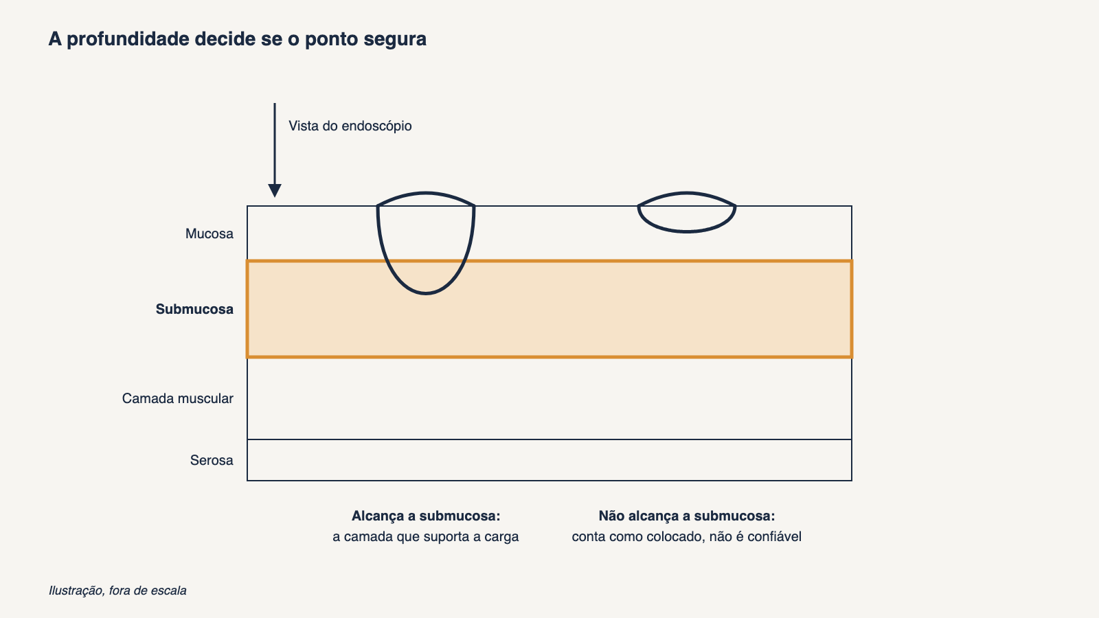 Corte ilustrativo da parede gastrointestinal em quatro camadas, mucosa, submucosa, camada muscular e serosa, com um ponto profundo que atravessa a submucosa destacada e um ponto superficial restrito à mucosa